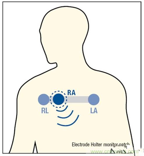 解析:一款可穿戴無線ECG動態(tài)心電監(jiān)護(hù)儀的設(shè)計